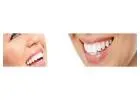 Straighten Your Smile Discreetly with Invisalign in Burwood | Huntingdale Dental Center