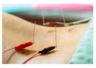 Dry Needling Therapy NYC